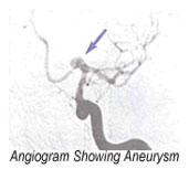 angiogram.jpg